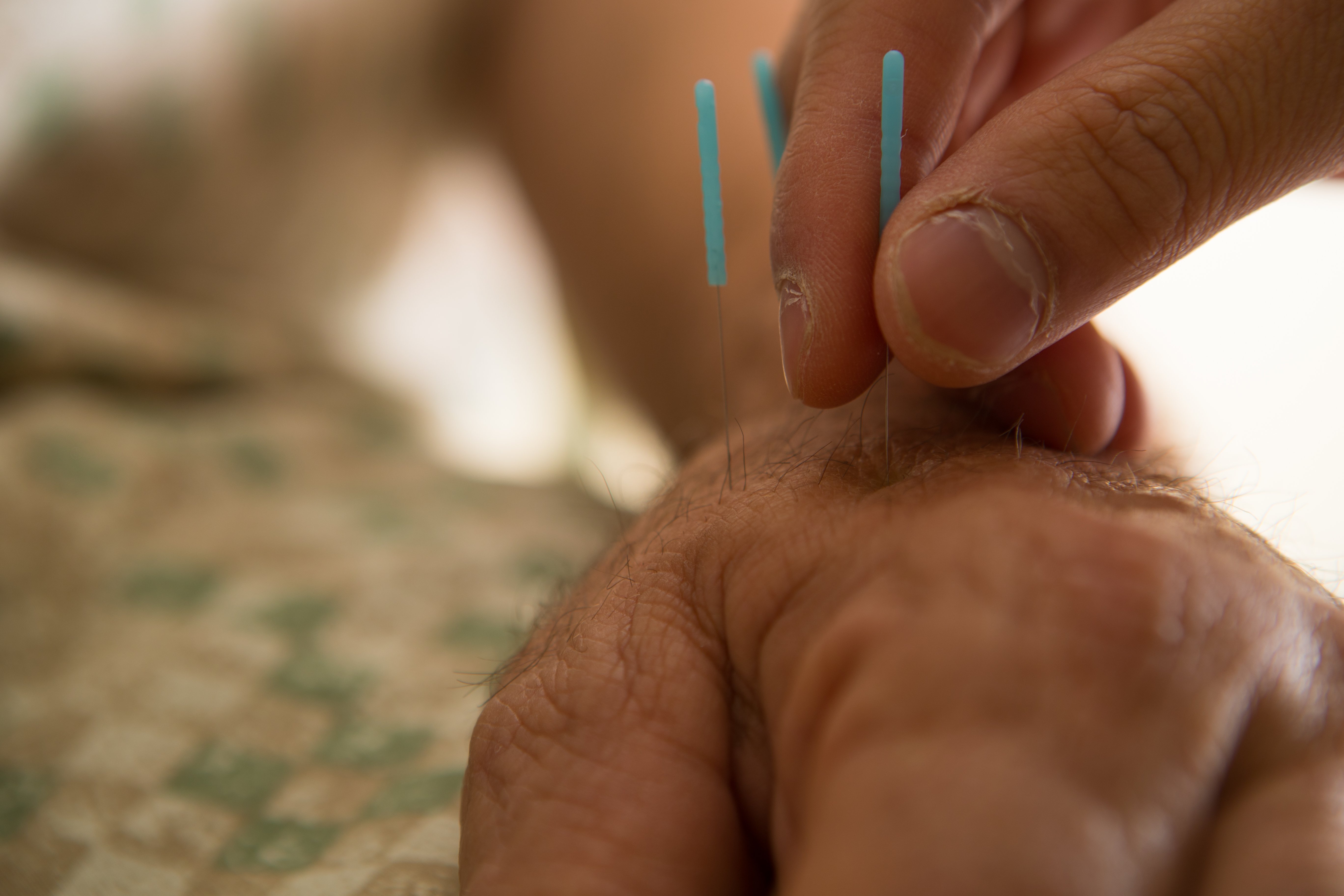 acupunture